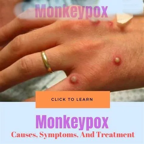 IClean monkeypox laboratory testing pcr diagnostic CE Mark certificate monkeypox virus rapid pcr test