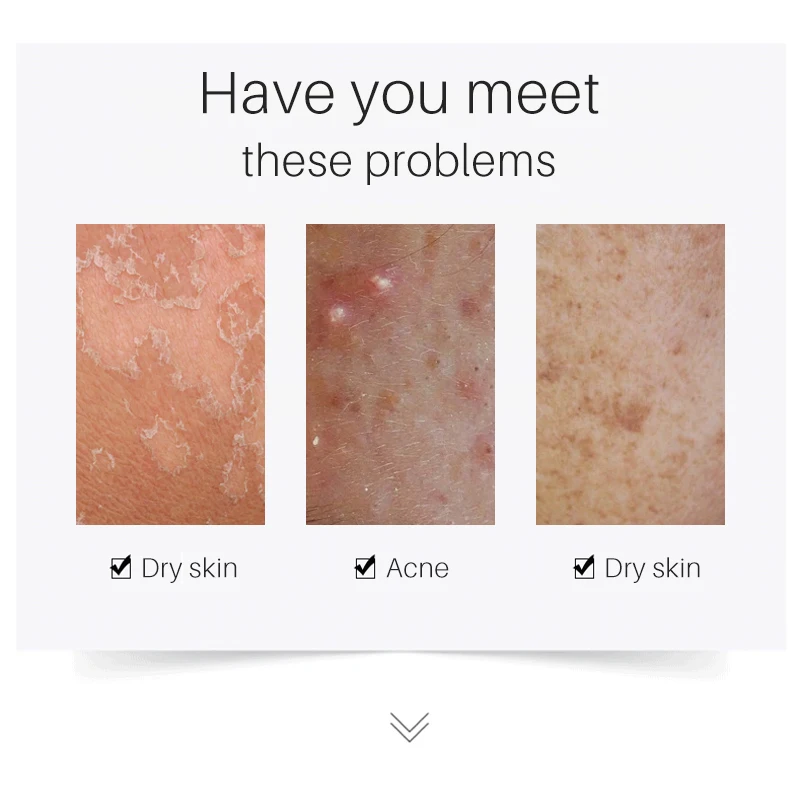 OEM Drying Lotion Acne Pimple Surface Blemish Removing Serum Dark Spot Remover Calamine Lotion