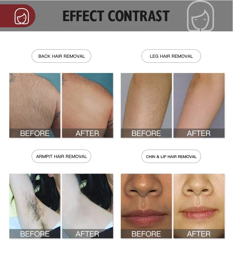 DIMEI OEM/ODM Beauty Equipment High Quality Diode Laser Hair Removal Machine Price