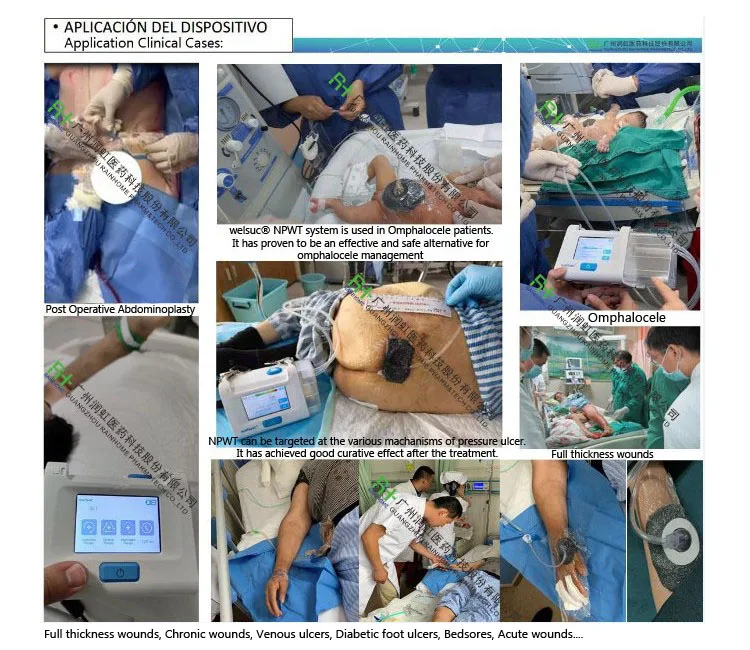 clinical case NPWT 1213