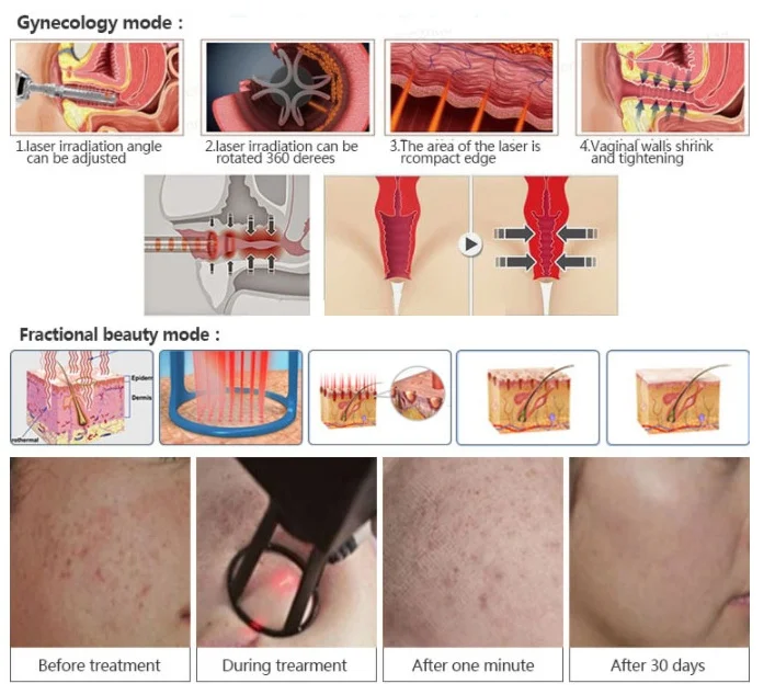 60W RF medical co2 laser Skin Resurfacing laser Rejuvenation vaginal tightening Portable Co2 Fractional laser machine