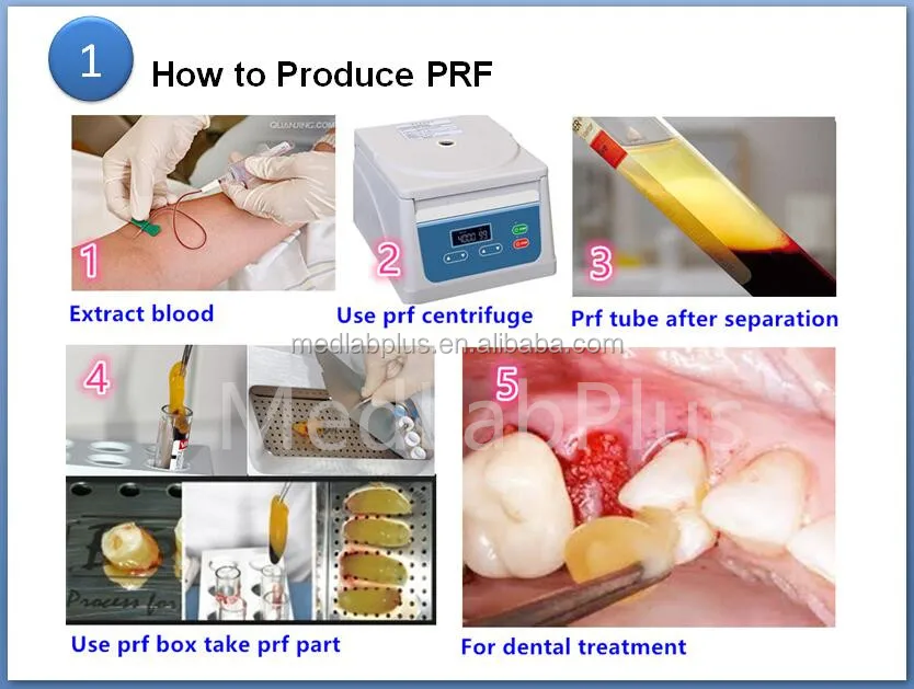 prf centrifuge dental