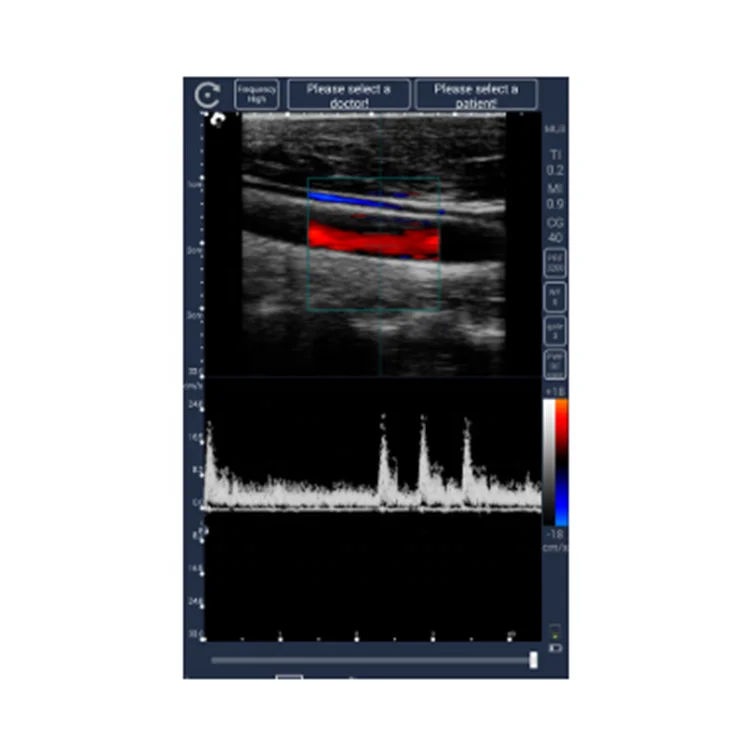 Healson Medical Ultrasound Machine With Color Doppler Usg