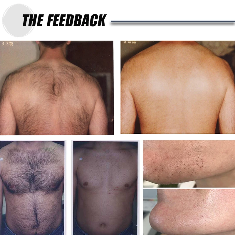 Winkonlaser Big Power 2000 Lazer Hair Removal Diodo Beauty Equipment 755 1064 808 Diode Laser Hair Removal Machine