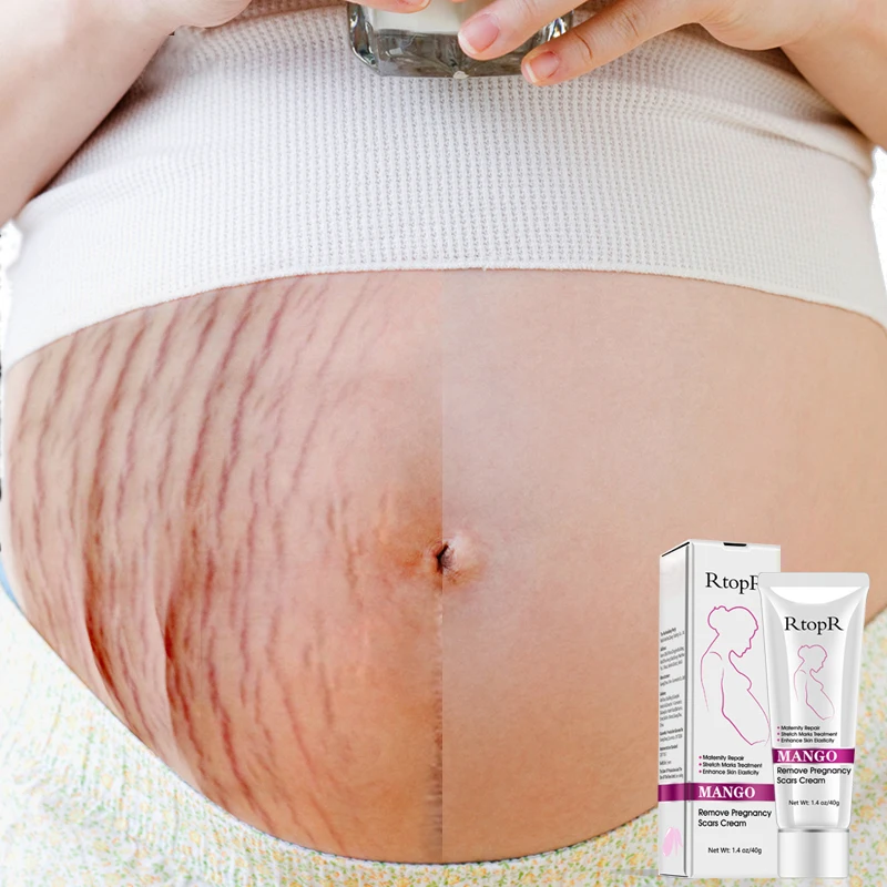 Rtopr Pregnancy Scar Removal Cream Pregnant Women Pigment Correction Repair Body Gel Firming And Brightening Stretch Marks