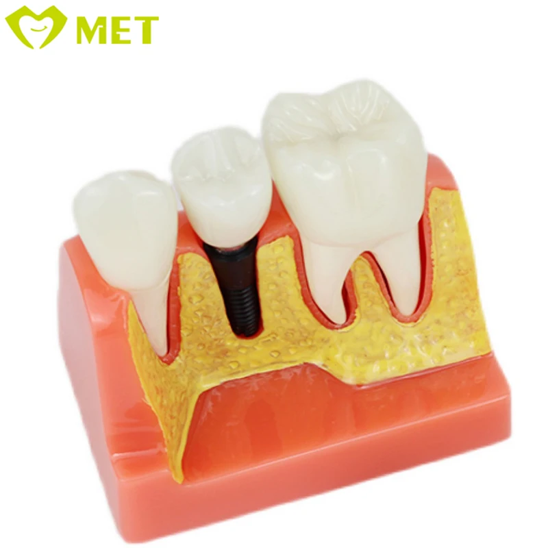 Meite medical 4 Times dental implant model/dental teaching model/dental removable teeth model