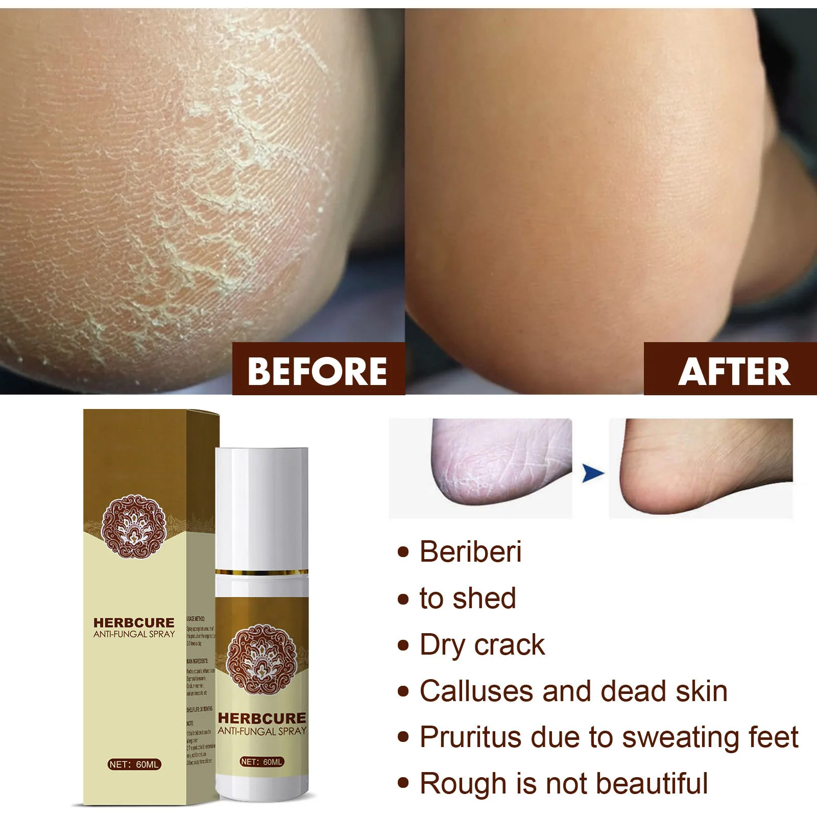 wholesale foot anti bacteria spray odor eliminator remove bacteria remove dead skin cells repair rough beriberi feet spray