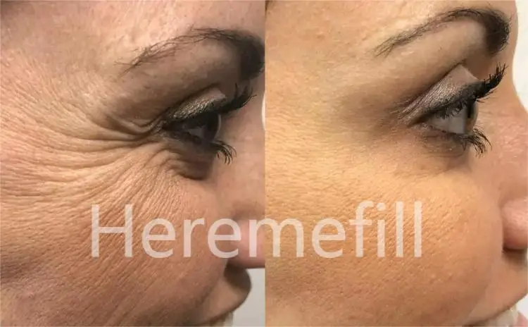 Heremefill  Injecting cross-linked gel hyaluronic acid skin filling facial filler facial wrinkles