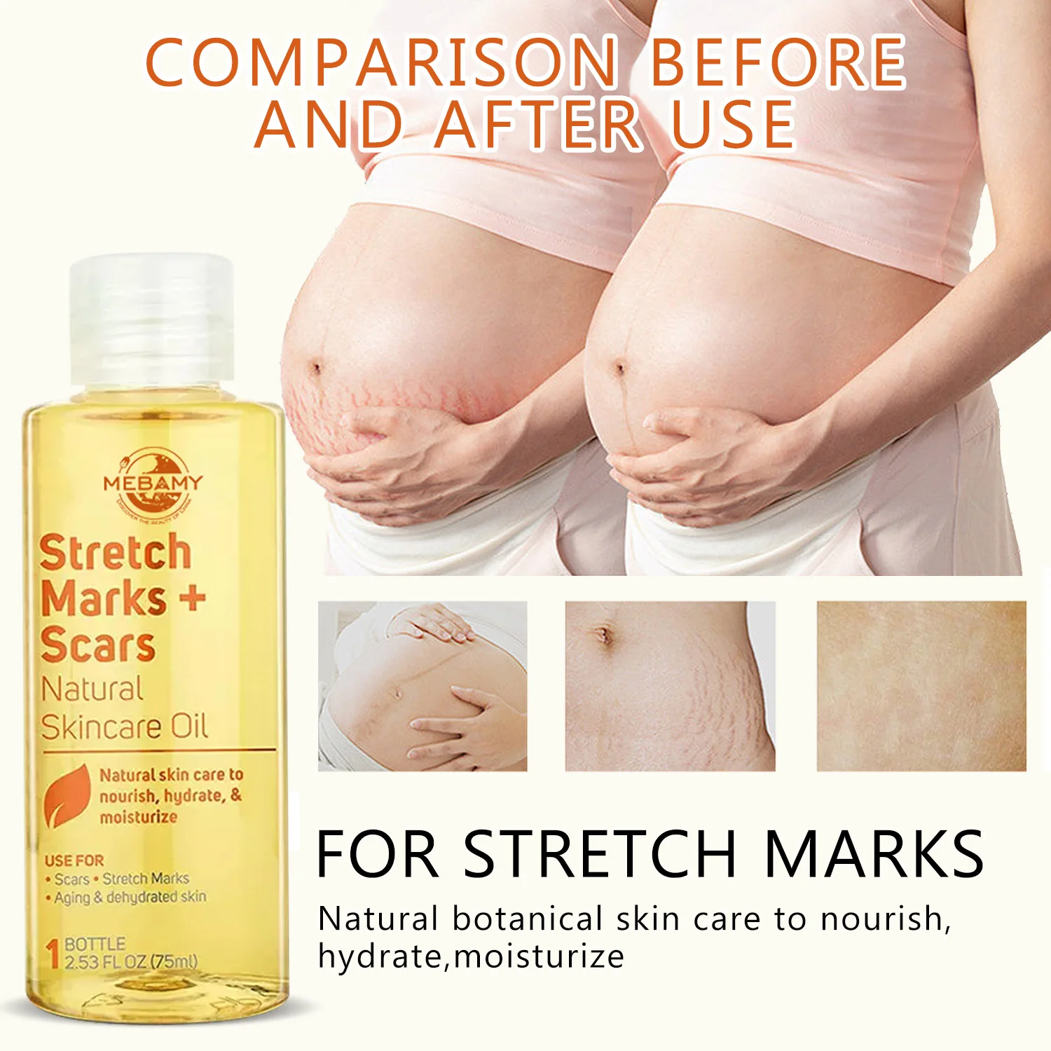 Best Sell Body Pregnancy Stretch Marks Removal Oil For Stretch Marks Anti Stretch Marks Oil Skin Care Repair Scar Removal Oil