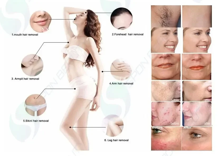 1IPL 360 Magneto / RF / Elight / ND Yag Laser for Black Carbon Wrist Skin Peeling Hair Removal and Tattoo Removal