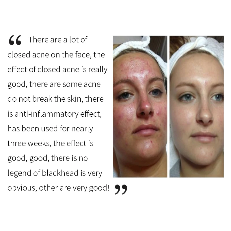 Pansly Dropshipping Private Label tea tree oil for acne scars Organic best oil for skin Tee Tree Toner  Essential Spray