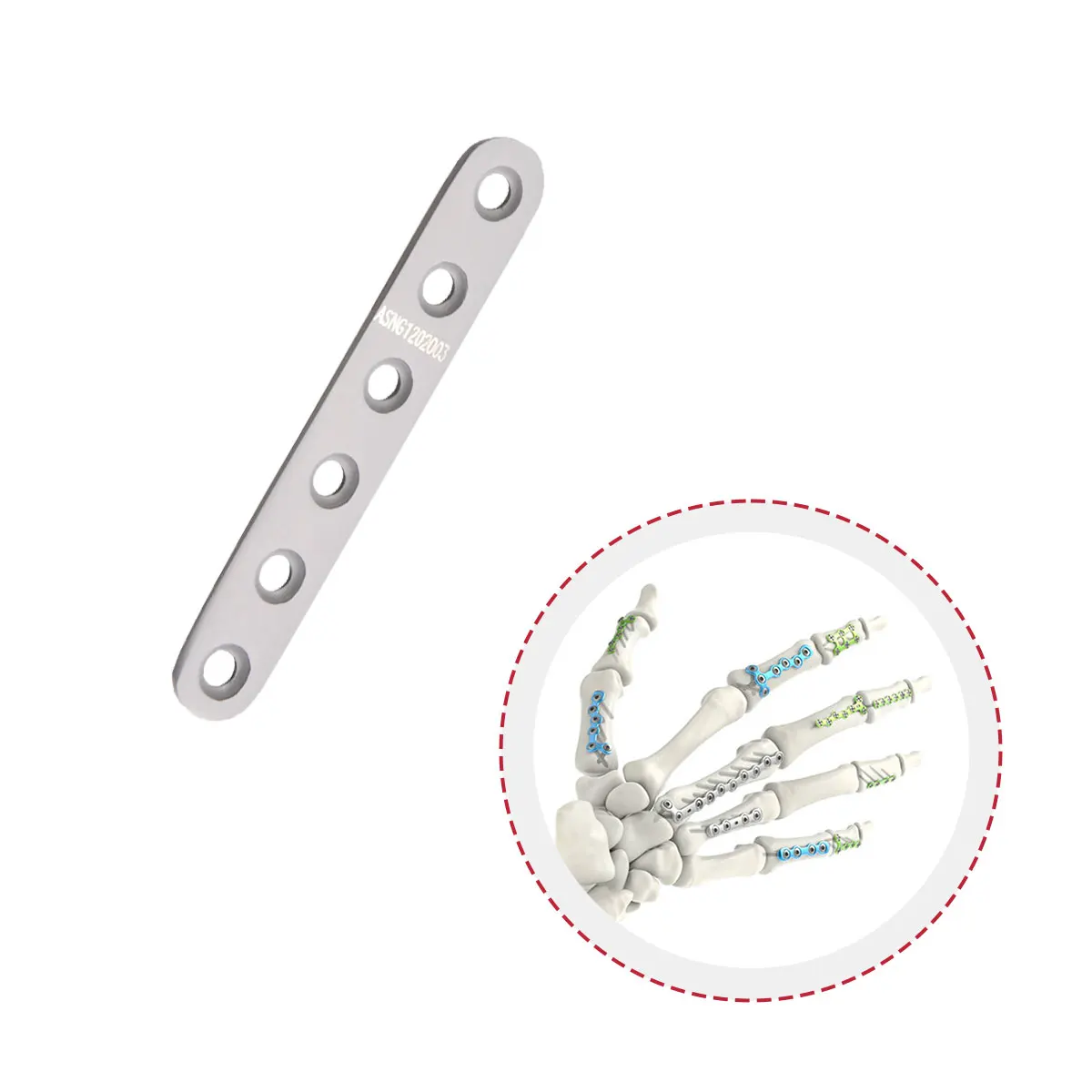 Orthopedic Implant Metacarpal Phalange Finger Fracture Hand Titanium Straight Bone Plate for Metacarpal
