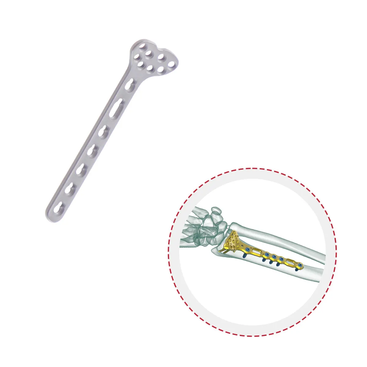 High Quality Factory Radius Distal Palm Orthopedic Implant Locking Compression Plate