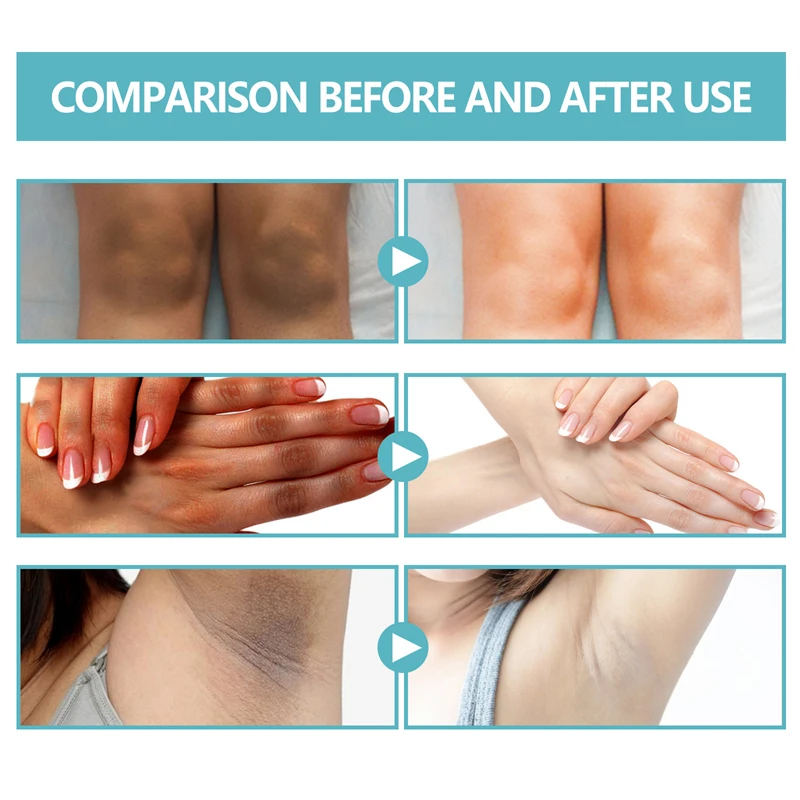 EELHOE 50g acanthosis nigricans therapy cream nape elbow knees knuckles back moisturizing brightening exfoliating cream