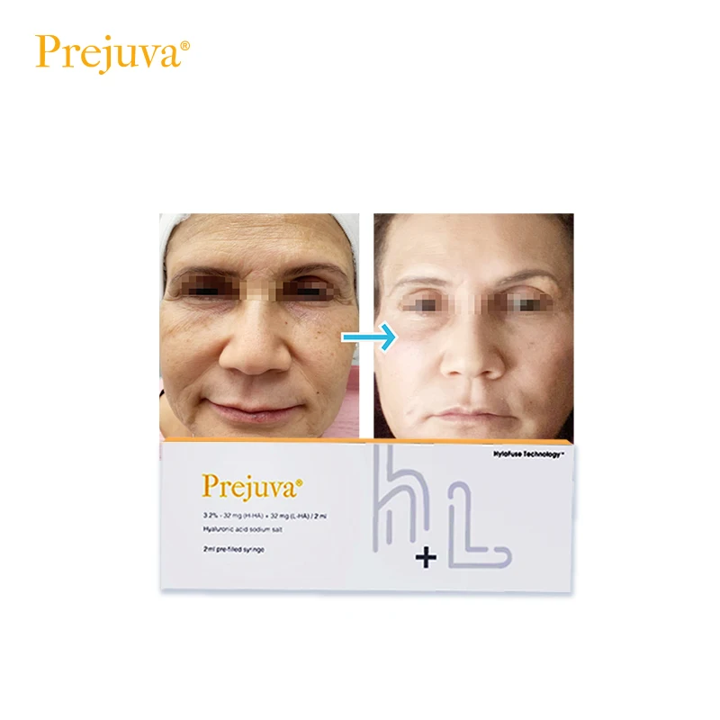 Prejuva Bio-Remodelling Product Hyaluronic Acid Forehead Dermal Filler Anti Wrinkles Skin Booster