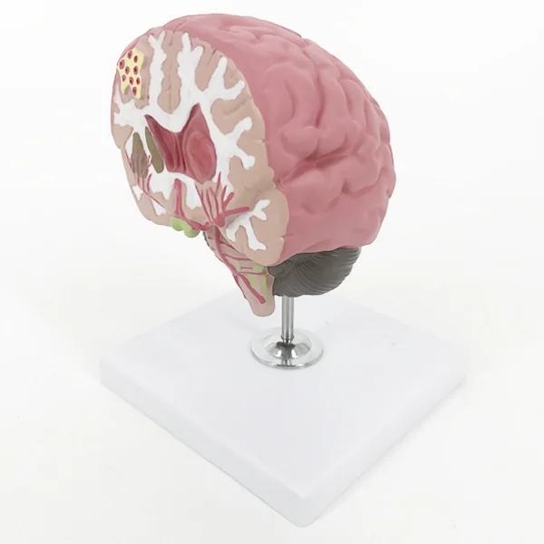 BMN/N051 Brain Stroke Model (Brain Disease Model)