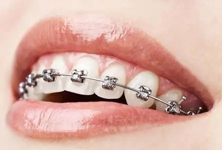 Dental orthodontics fixed teeth with high quality metal brackets/Dental orthodontic materials high-grade  metal brackets