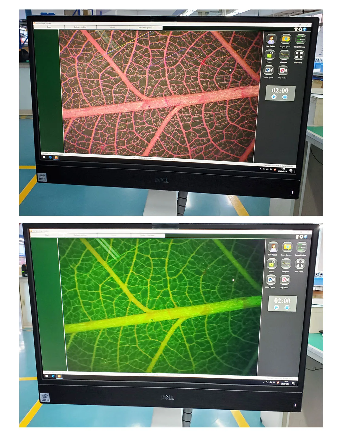 Kernel KN-2200BII Integrated 3D Medical Optical Colposcope for Gynecology Vaginal Diagnosis Auto-focus Digital Colposcope