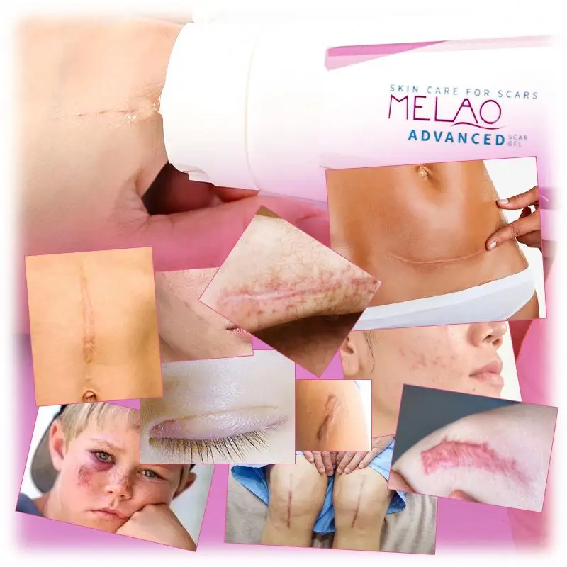 private label free sample Scar and anti acne mark removal gel ointment silicone advanced  silicone Scar Remover Gel