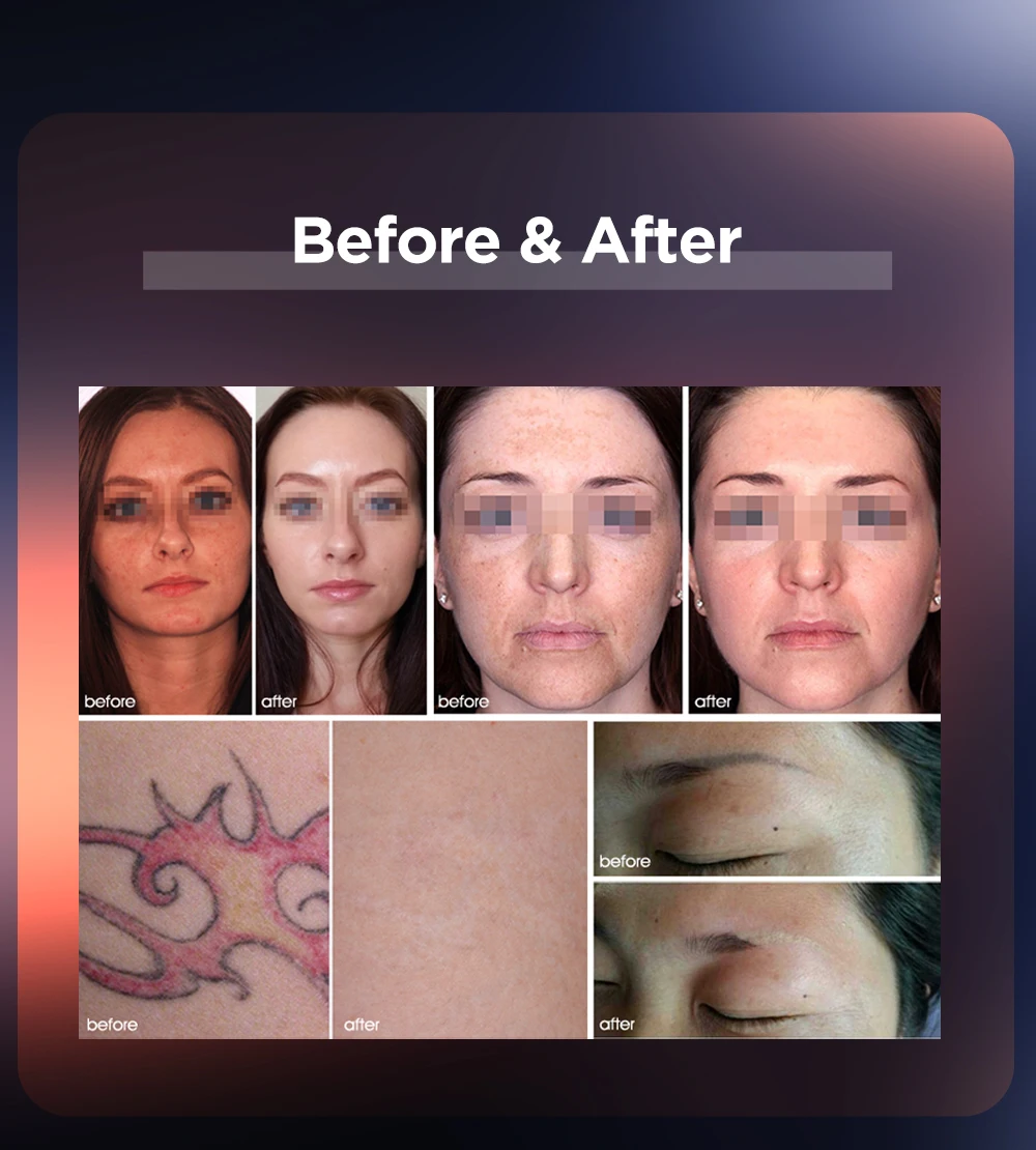 ADSS Nd Yag Laser Tattoo Removal Professional Big Spot Removal Carbon Peel Skin Rejuvenation Laser Beauty Machine