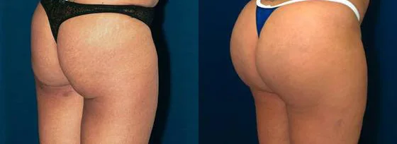 breast and buttock injections injectable hyaluronic fillers for Body use 