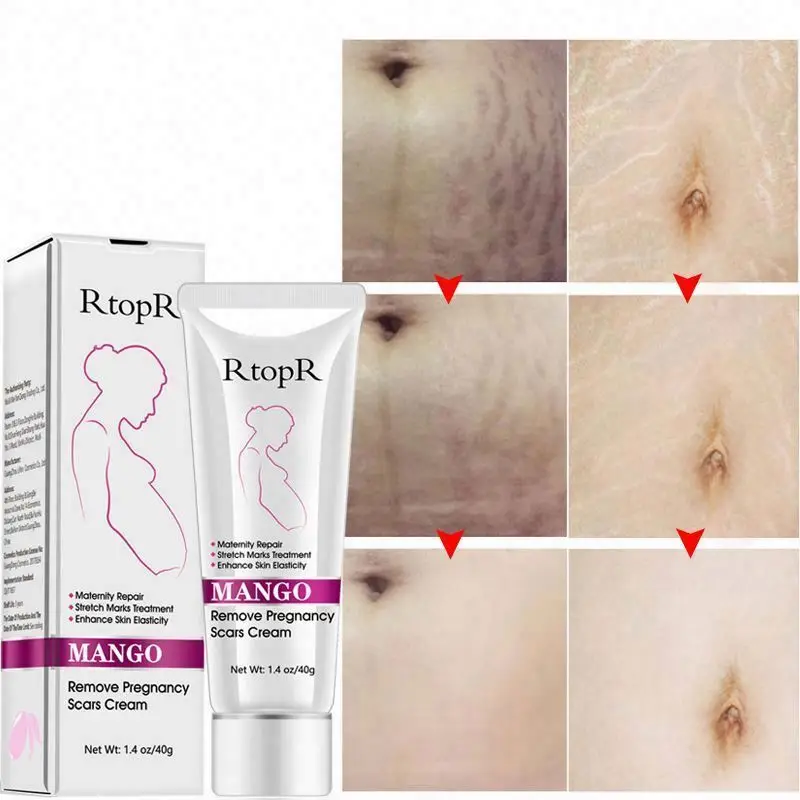 Wholesale beauty care Anti Stretchmarks remove no harm and irritation to skin cream for stretch mark Wholesale beauty care Anti