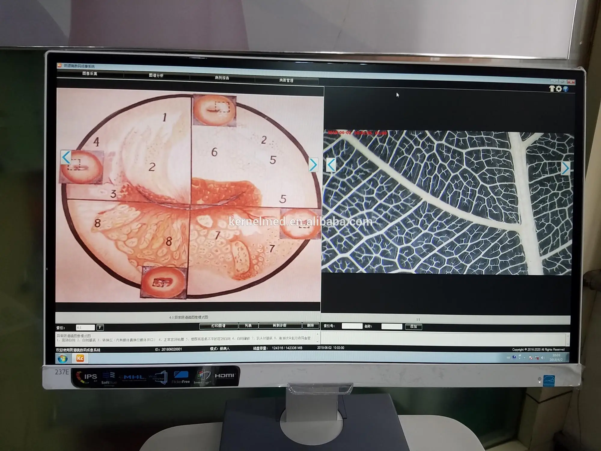 Оптический кольпоскоп с CCD-камерой гинекологический микроскоп кольпоскопия видео KN-2200BI портативный видеокольпоскоп