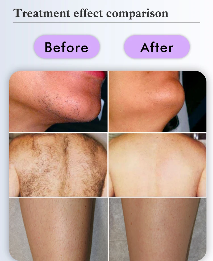 Big Spot Size 755nm 1064nm Nd Yag Alexandrite Laser Ontharing Machine Prijs