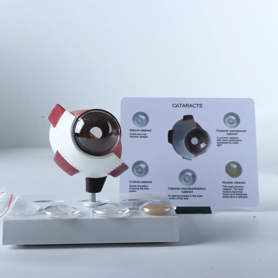 Eye Pathological Anatomical Model For Medical Education Eye Disease Model Of Cataract