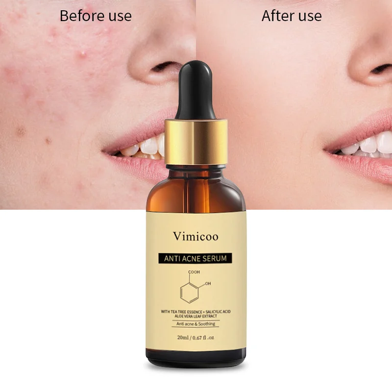 Private Label Organic Herbal Tea Tre Salicylic Acid Face Skin Anti Acne Treatment Serum For Acne Removal