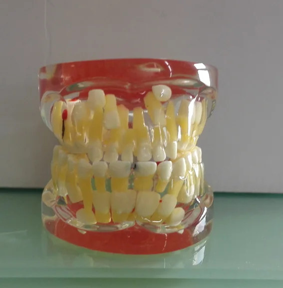 BIX-L1006 Transparent baby teeth pathological dental model