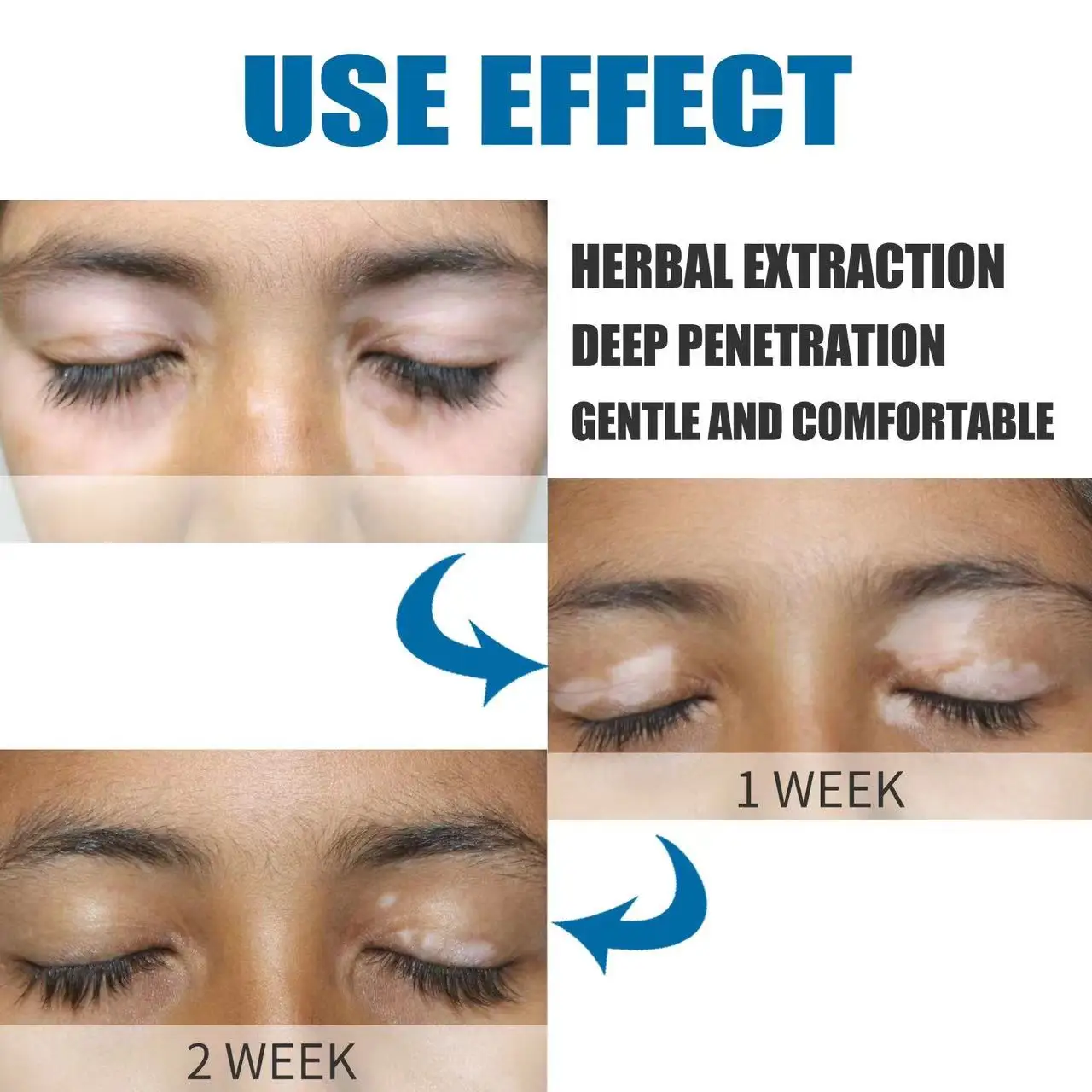 White Spot VitiligoTreament White Spot Skin Repair Psoriasis Localized Vitiligo Ointment Leukoplakia Treatment