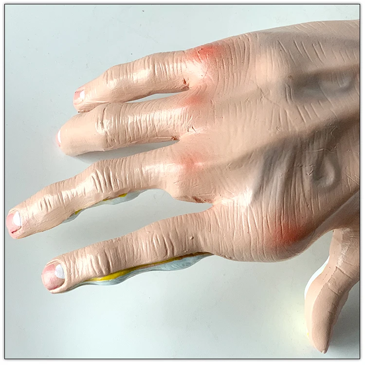 Anatomical model of human hand joint   Arthritis    Rheumatic fever