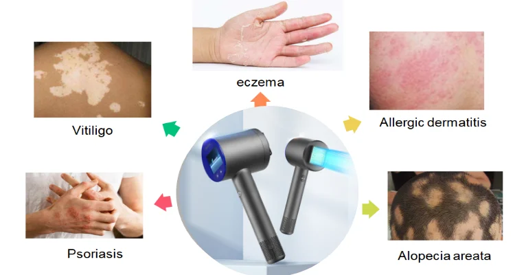 Peninsula Hot Sale 308nm UV LED Light Lamp Treatment For Skin Psoriasis