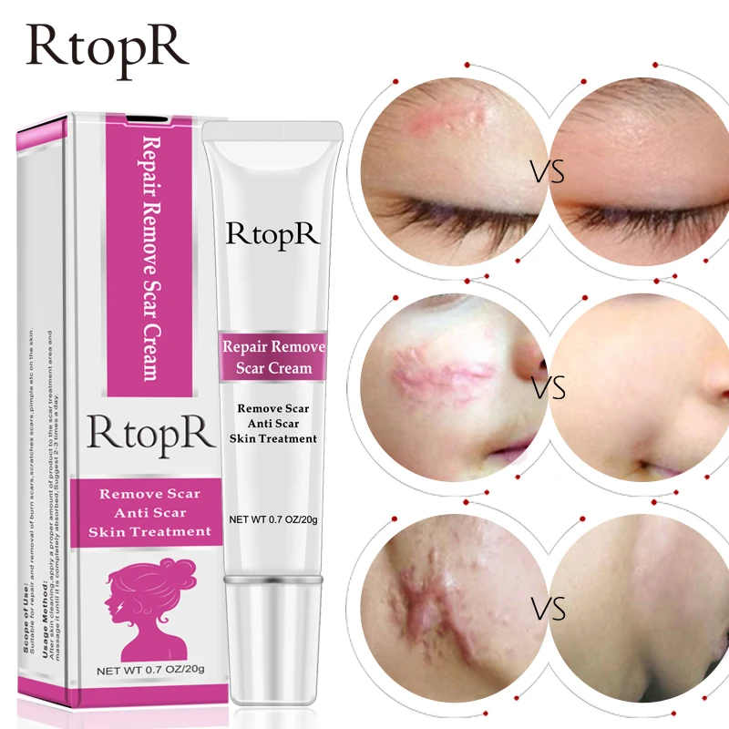 Good effect  removal scar anti scar  Acne Scar Removal Cream skin care treatment