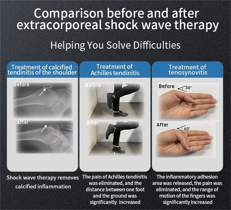 2024 Newest cheap price back pain relief physical therapy focused extracorporeal shockwave therapy machine