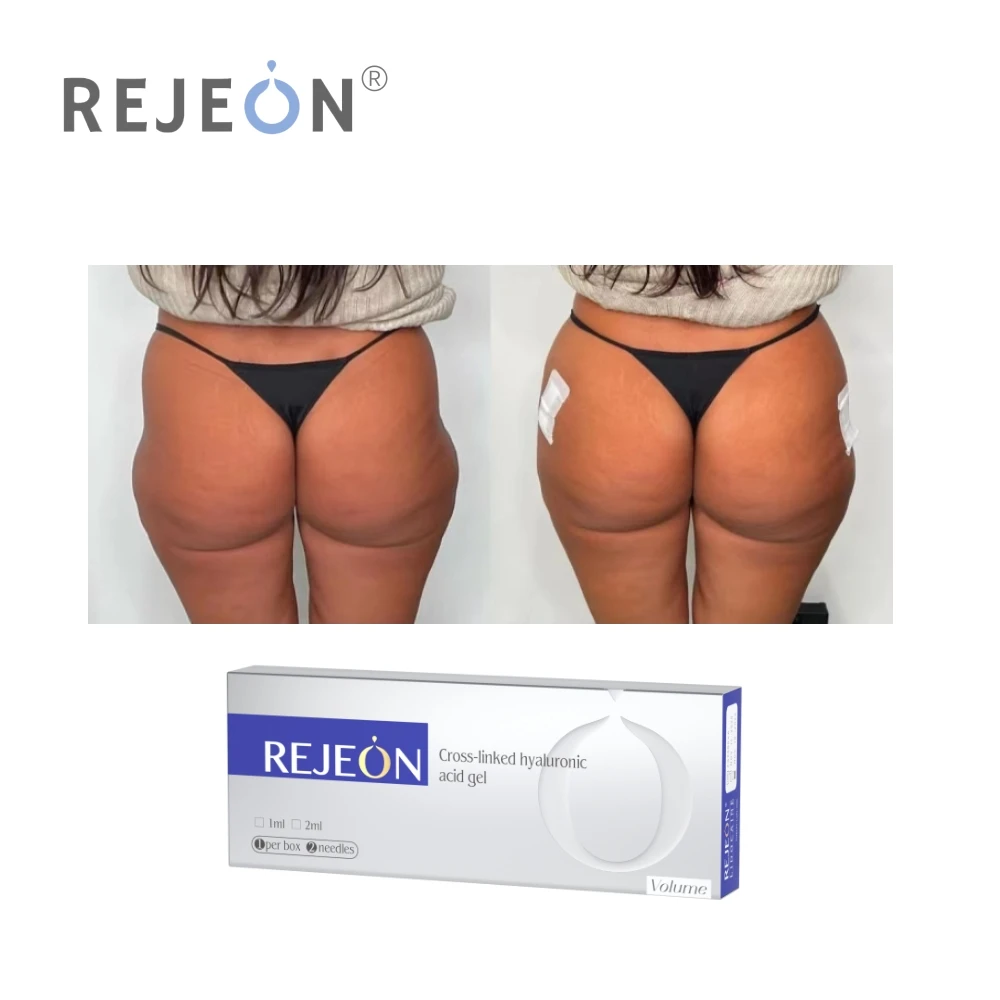 Hot sales REJEON hyaluronic acid butt filler for buttocks injection poly-l-lactic acid butt dermal filler  for butt enhancement