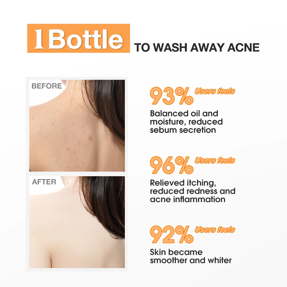 Refreshing Gel Body Wash Salicylic Acid Sulfur Infused Anti-Acne Anti-Mite Skin Care Adults Herbal Formula Liquid SKINEVER