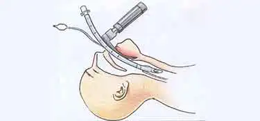 trachea-cannula.jpg