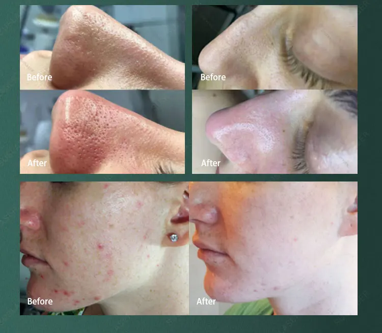 Hottest 8 in 1 Multifunction Hydro Microdermabrasion Machine oxygen jet/ Oxygen Facial Machine