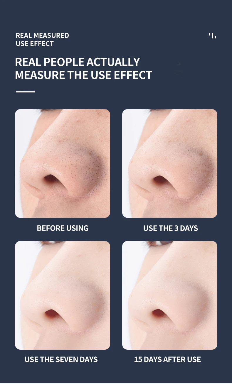 vacuum blackhead remover