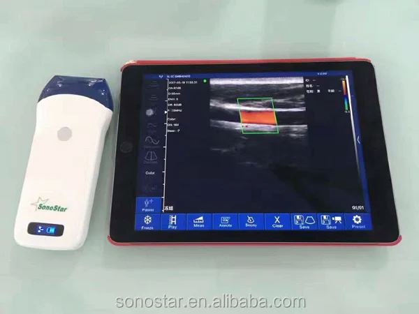 PICC / CVC Use Wireless Ultrasound Scanner Needle Guide for Vein Puncture in Guangzhou