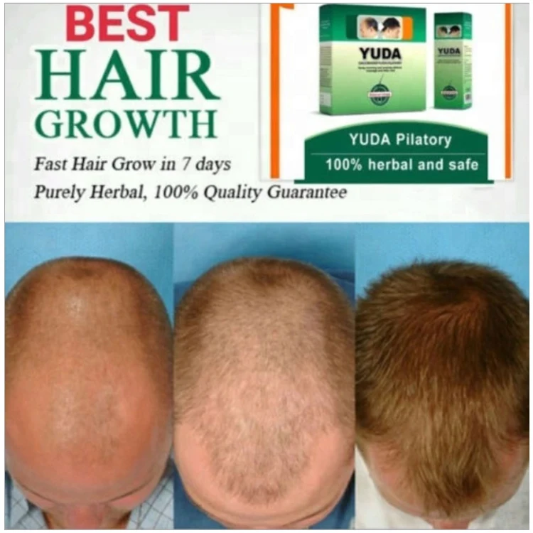 yuda fast pilatory hair growth hair growth spray hair growth fluid with private label