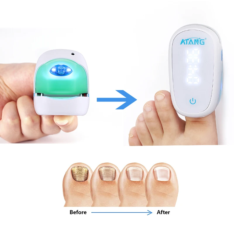 ATANG Onychomycosis fungus nail toenail fungus Nail Fungus Treatment laser