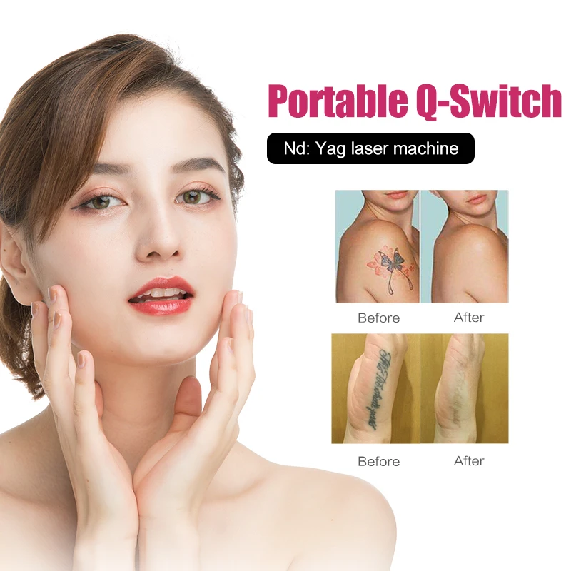 newest best quality laser nd yag laser machines tattoo removal for dark skin