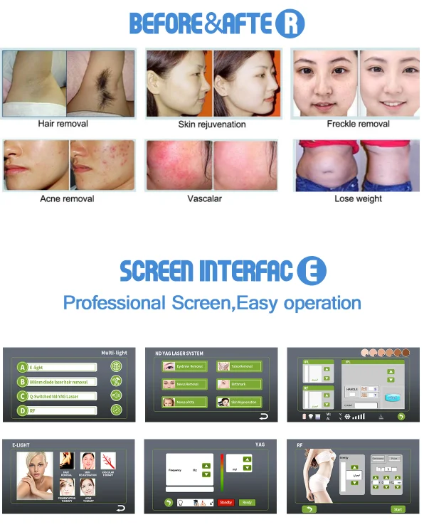Global Supply 4in1 808 Diode Laser Hair Removal Elight Skin Rejuvenation ND YAG Tattoo RF Lifting Beauty