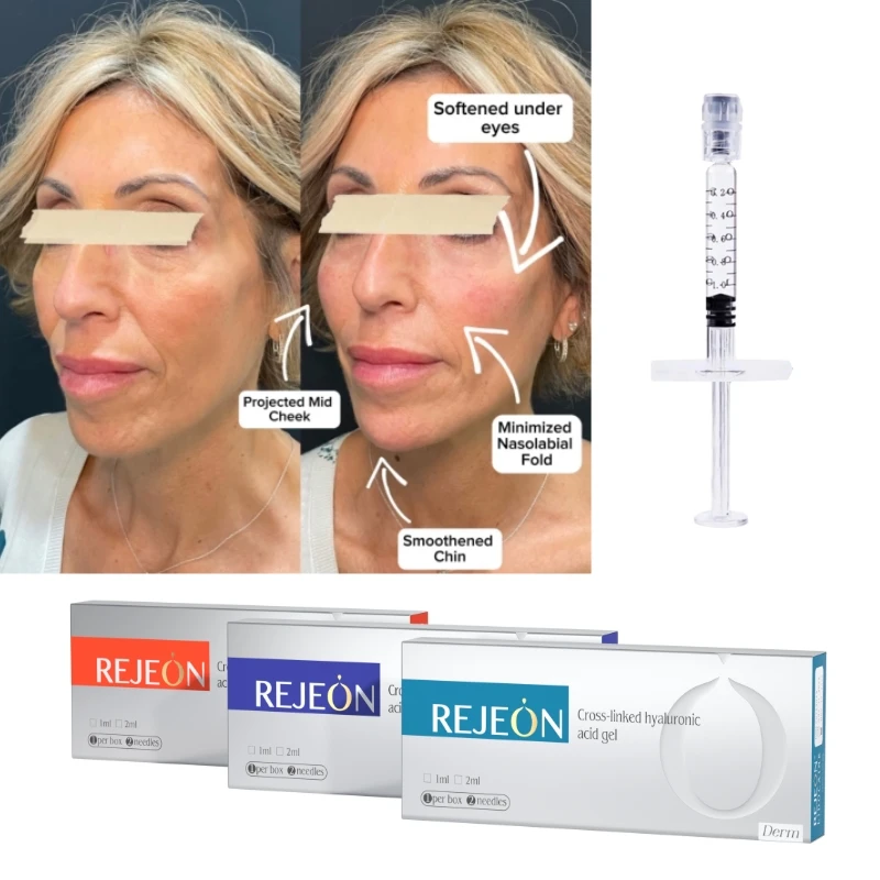 REJEON Original manufacturer supply 100% pure injectable Hyaluronic Acid HA Face Dermal Filler to remove Smile lines