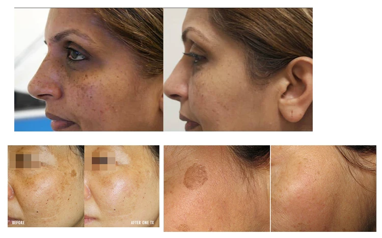 before and after pico.jpg