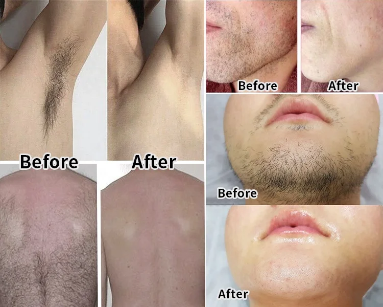 808 Diode Laser Hair Removal Machine 755nm/1064nm/808nm Diode Laser Germany Stationary Ice Titanium 4000W