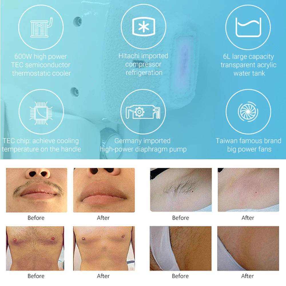 Areslite 2000W 3000W Powerful 810 808Nm Ice Diodo 4 Wave Diode Laser Depilation 808 Nm Hair Removal 4 Waves Medical Machine